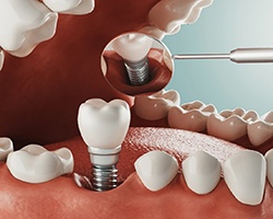 Diagram of dental implant surgery in Vero Beach