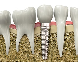 Diagram of dental implant in Vero Beach during osteointegration 
