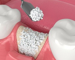 Digital illustration of bone grafting