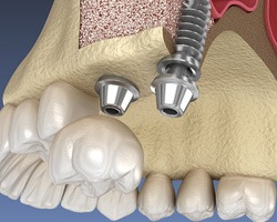 Digital illustration of a sinus lift