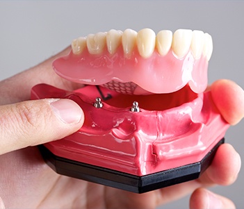 Model all-on-4 denture
