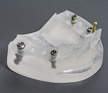 Model of all-on-4 implants in place