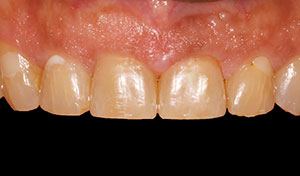 indian river county dental implant totoh replacement