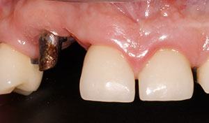 Missing back teeth before vero beach dental implant bridge