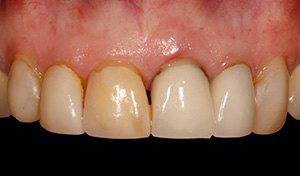 Damaged back teeth before indian river county dental care