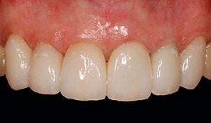 Anterior Teeth Improvement in Vero Beach, FL