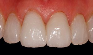 Vero Beach ceramic dental crowns