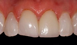 Damaged teeth before indian river county dental crowns