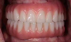 Patient with flawless smile after vero Beach Implant Dentures