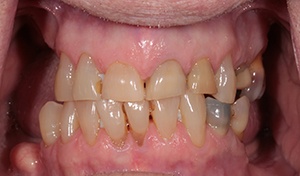 Patient With Damaged Teeth Before Vero Beach Implant Dentures