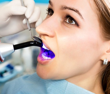 A curing light is used to bond resin to a patient’s tooth