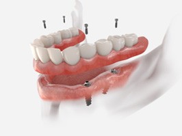 a graphic illustration showing how implant dentures work