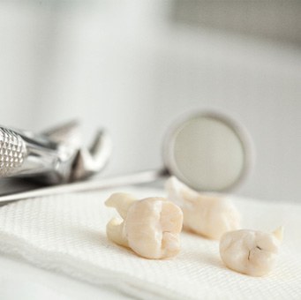 Close-up of teeth after tooth extraction in Vero Beach, FL