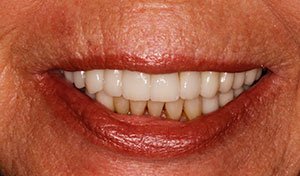 Flawless smile after indian river county full mouth dental rehabilitation