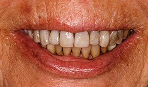 Severely damaged smile before indian river county full mouth dental rehabilitation