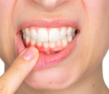 Woman showing red gums