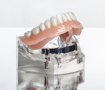 Implant dentures in Vero Beach attached to a model