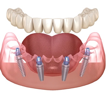 Diagram of denture that attaches to dental implants in Vero Beach