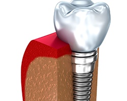 A digital image of a single tooth dental implant in Vero Beach