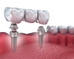 A digital image of an implant bridge located on the lower arch in Vero Beach