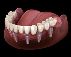 A digital image of an implant denture replacing the bottom row of teeth in Vero Beach
