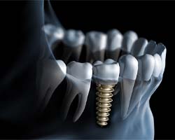 Dental implant in Vero Beach, FL after receiving crown