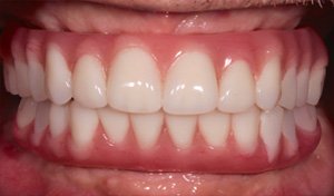 After Implant Retained Dentures Procedure