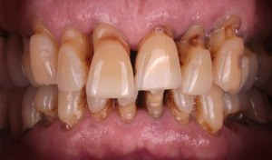 Before Implant Retained Dentures Procedure