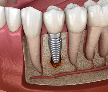 Failed dental implant in Vero Beach