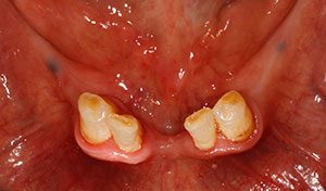 Missing teeth before palcement of vero beach lower hybrid denture