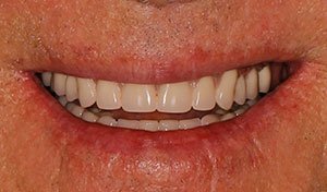 Full smile after lower implant retained denture placement vero beach