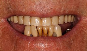 Missing bottom teeth before lower implant retained denture vero beach