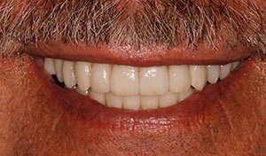 Vero beach lower dental implant denture