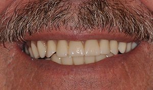 Damaged smile in need of lwoer denture vero beach