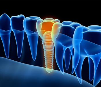 3D animaiton of implant suppored dental crown