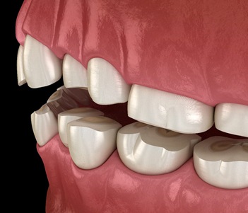 computer model of teeth grinding against each other