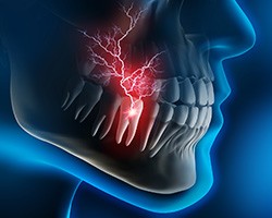 X-ray illustration of a toothache in Vero Beach