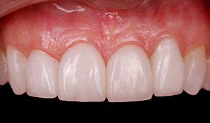 Vero Implant & Esthetic Dentistry porcelain veneers