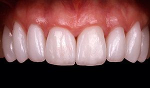 Flawless smile after vero beach dental veneers