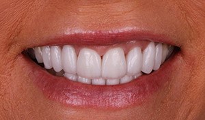 Perfect smile after vero beach dental veneers