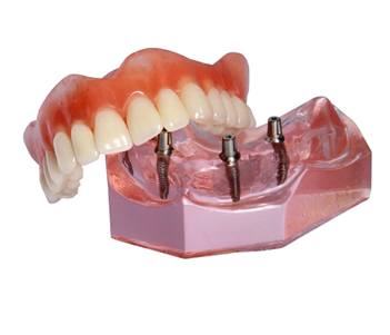 Model of Teeth in a Day treatment against white background