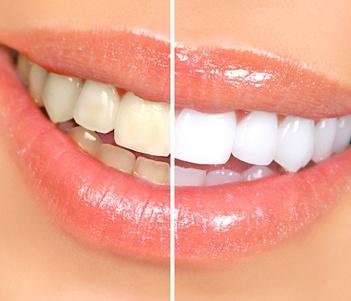 Before and after image of a teeth whitening treatment