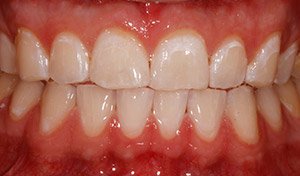 Vero Beach teeth whitening results from cosemtic dentist