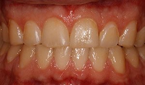 Discolored teeth before vero beach teeth whitening from cosemtic dentist