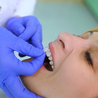 A dentist placing a patient’s veneers