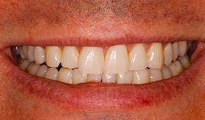 Discolored smile before indian river county cosemtic dentistry teeth whitening