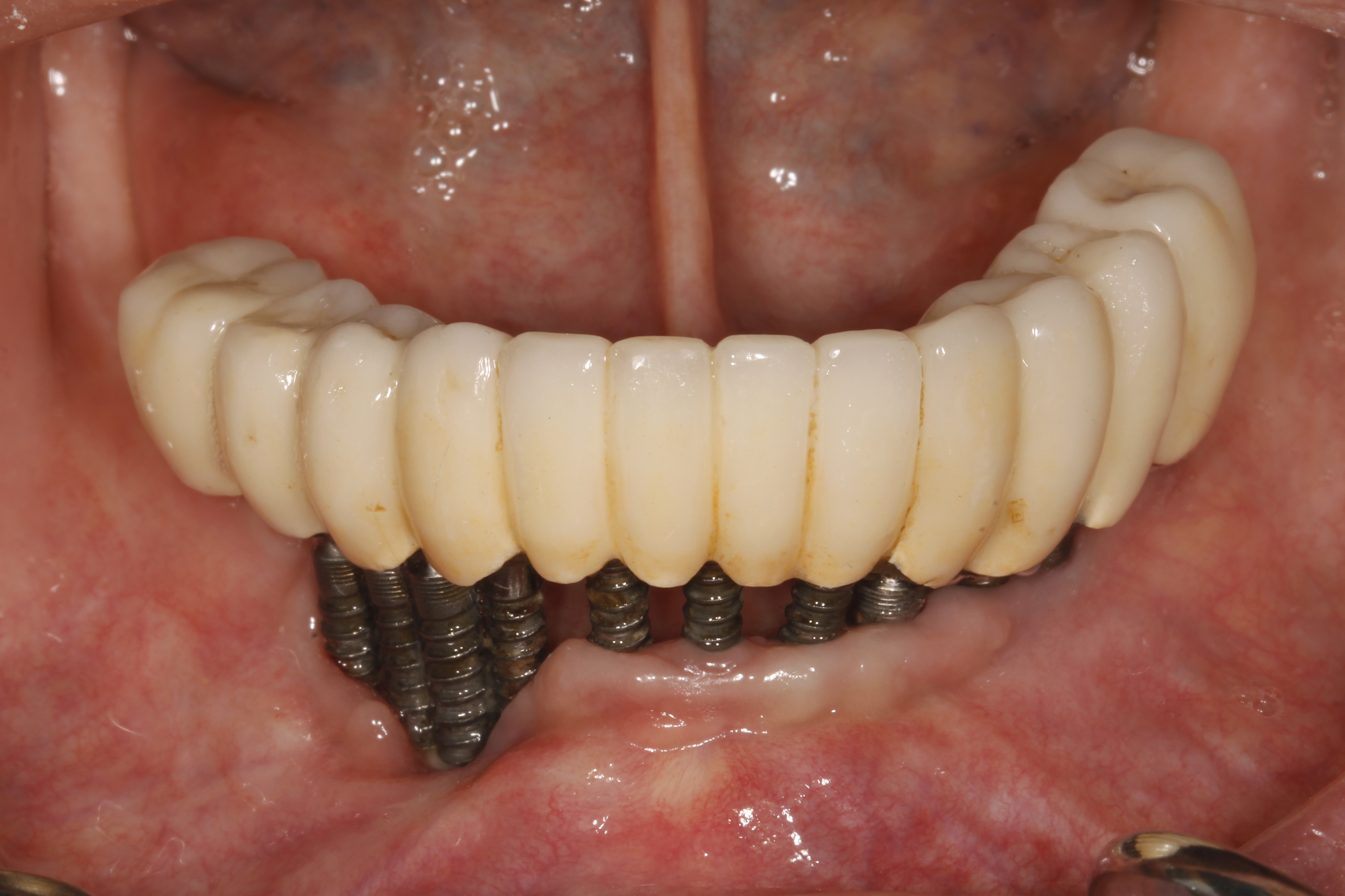 hybrid dentures in vero beach