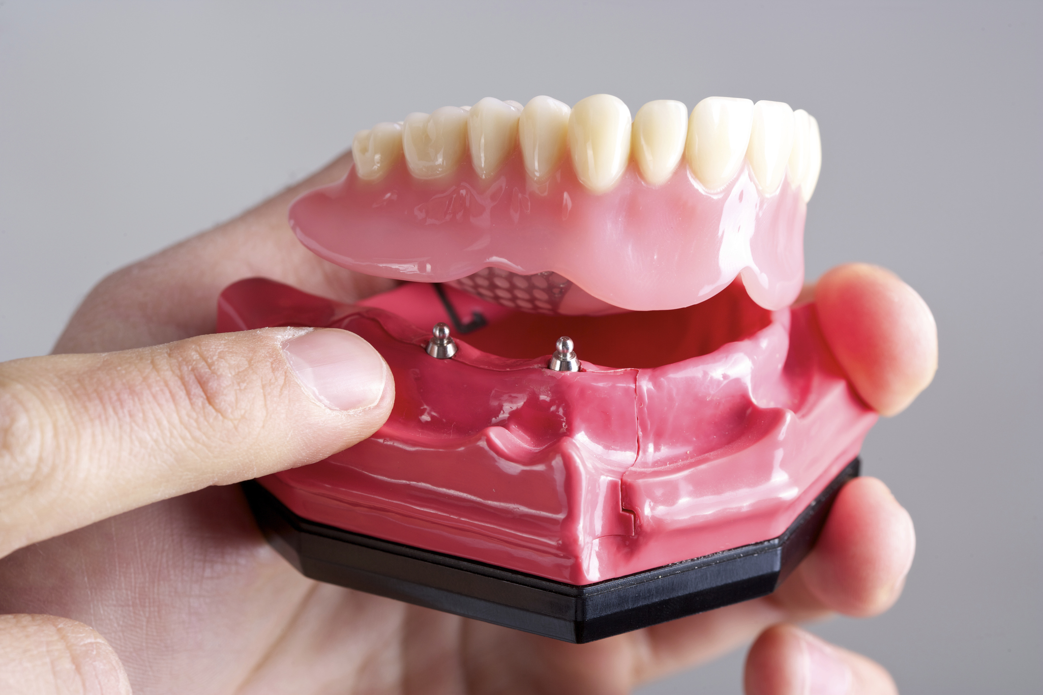 Hand pointing to model of All-on-4 implant denture