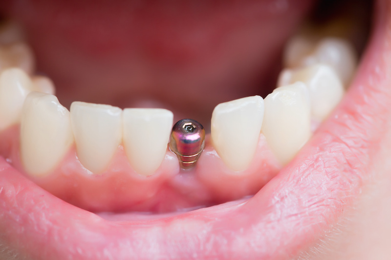 Does Smoking Cause Dental Implants to Fail?