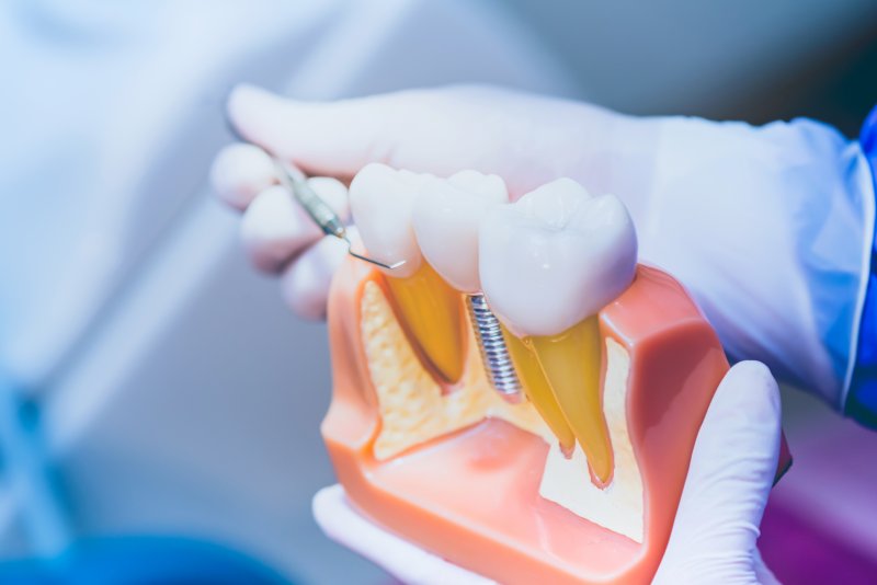 Dentist pointing to model of dental implant